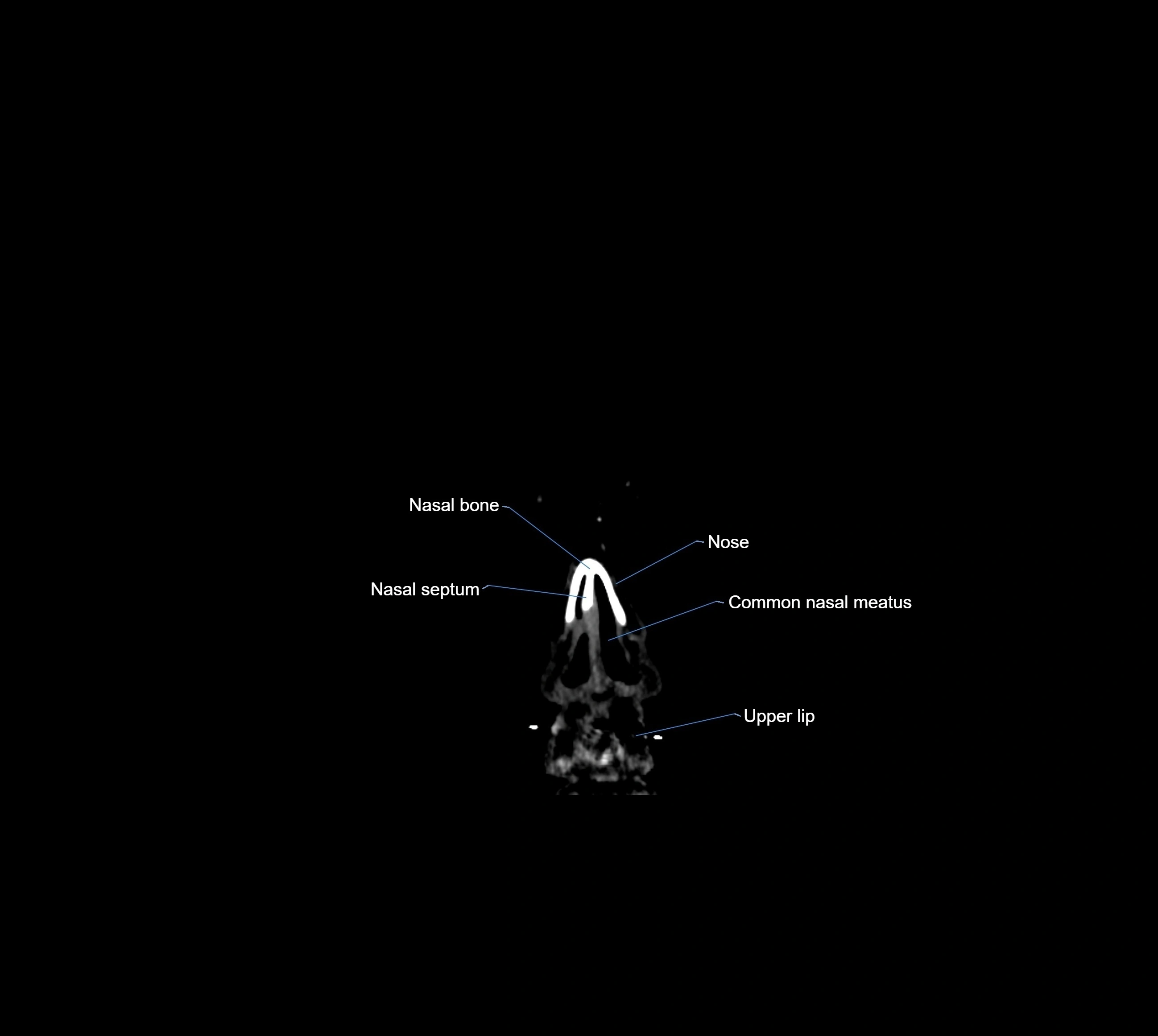CT Brain coronal cross sectional radiology anatomy image  -img-00001-02.webp